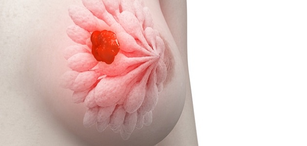 ما هي الأعراض المبكرة لسرطان الثدي